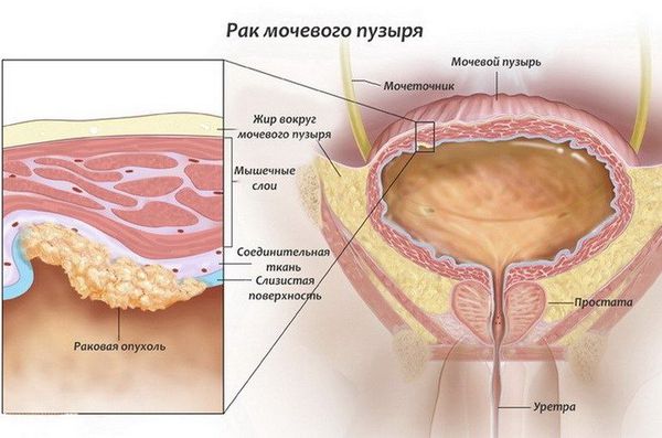 Злокачественная опухоль в мочевом пузыре