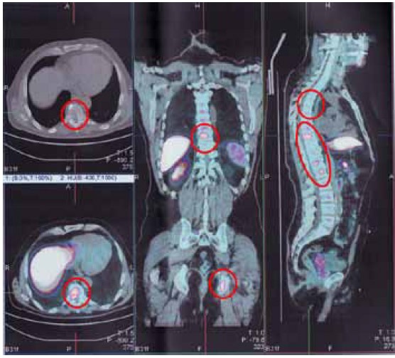 На кт виден рак. ПЭТ-кт опухоль позвоночника. Метастазы в костях позвоночника на кт.