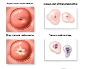 Рак шейки матки симптомы фото 46