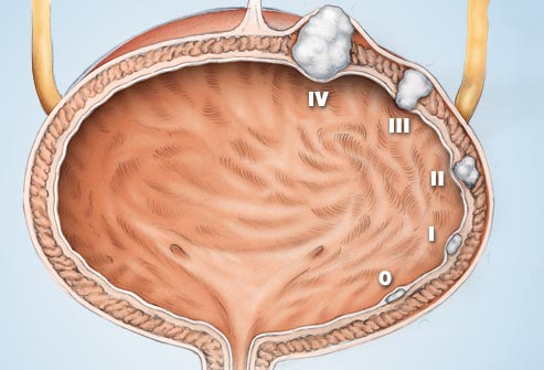 Фото с изображением поражению органа опухолью на разных стадиях ее развития