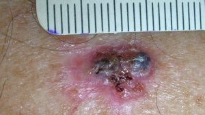 Плоскоклеточный рак кожи