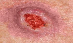 Плоскоклеточный рак кожи с изъязвлением