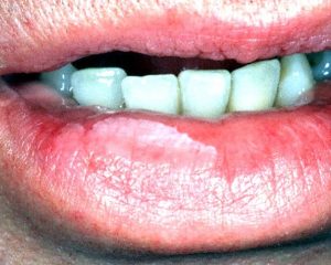 Лейкоплакия на слизистой губ