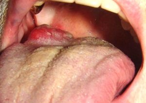 Рак языка, папиллярная форма