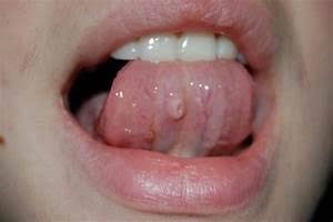 Рак полости рта начальная стадия