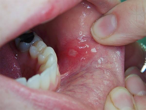 Как выглядит рак полости рта