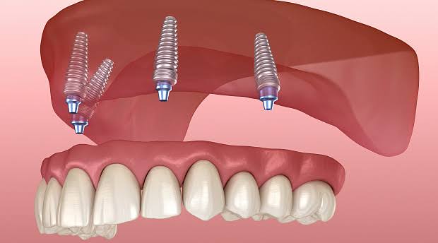 Установка зубных имплантов