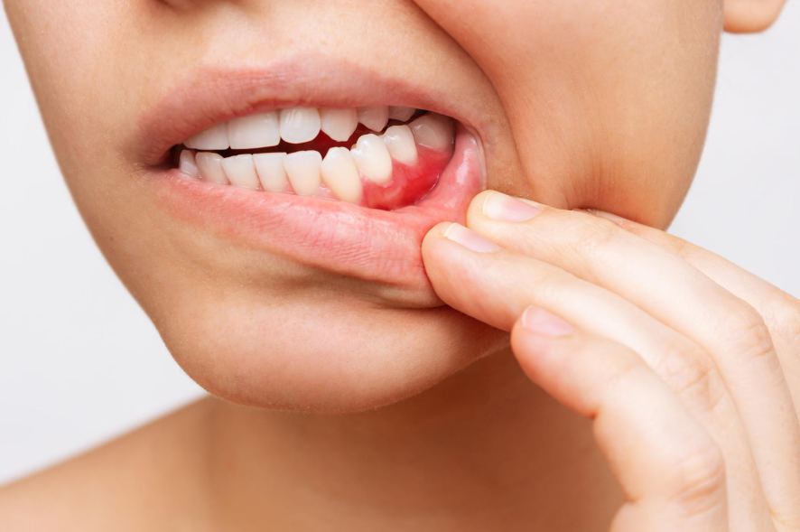 Рак и его связь со здоровьем полости рта